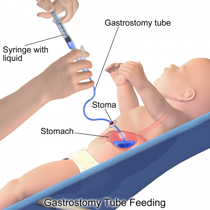 Gastric_Feeding_Tube_Infant